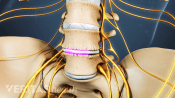 Anterior view of the lumbar spine showing healing over the bone graft inserted for a spinal fusion.