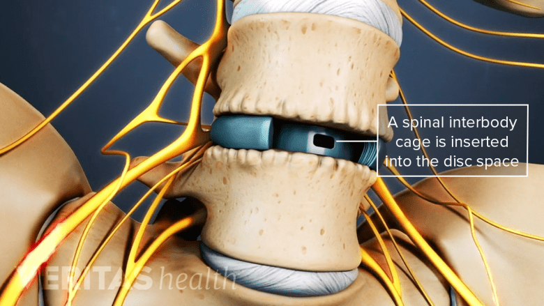 Illustration showing Interbody cage in the disc space
