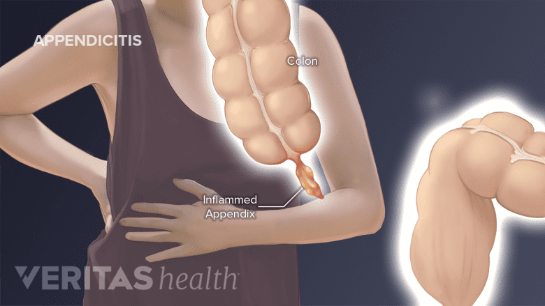 Medical illustration of appendicitits