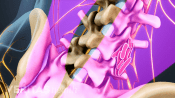 Posterior view of the lumbar spine showing location of bone graft.