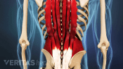 Illustration of microtears in the lower back muscles