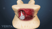 Bone cement injections during kyphoplasty