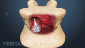 Bone cement injections during kyphoplasty