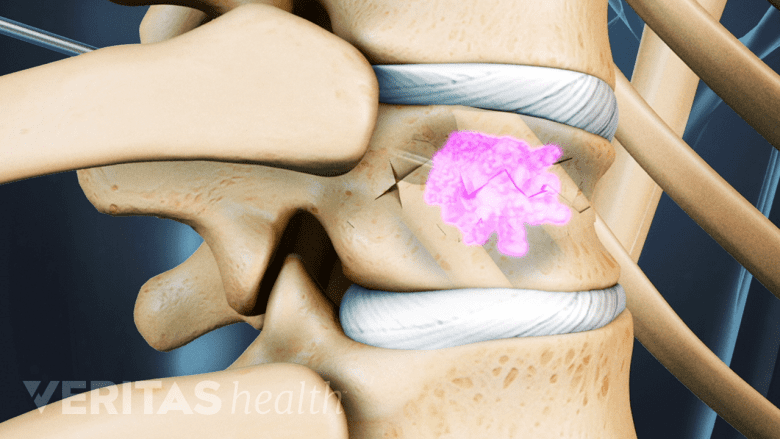 Vertebroplasty: Bone cement being used to treat a spinal compression fracture.