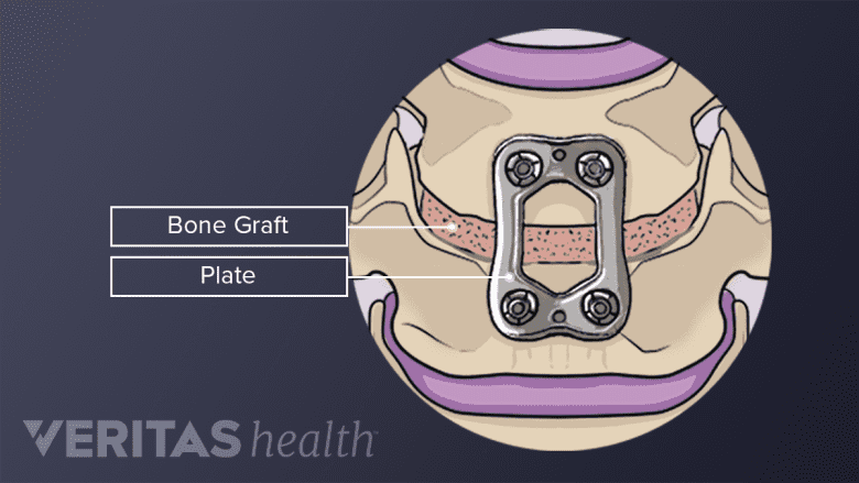 Two vertebrae with bone graft, plates, and screws.