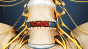 Bone graft healing over the implant and fusing L4 and L5 together