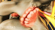 Posterior view of lumbar spine with bone spurs.
