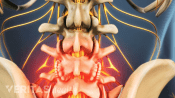Bone spurs in the lower spine radiating pain