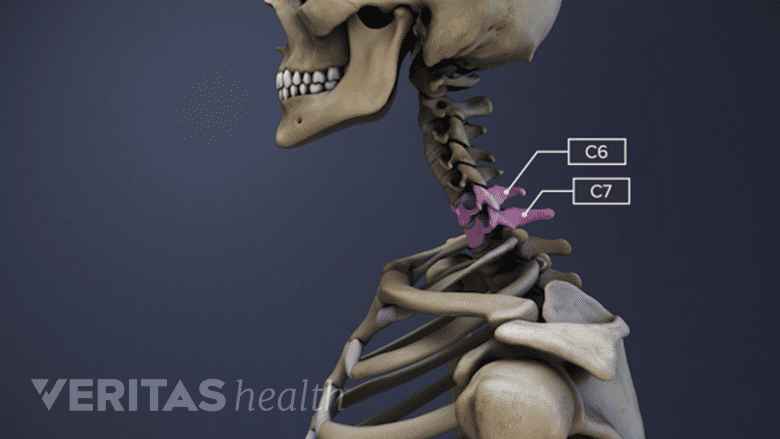 Illustration of the head, neck, shoulders of a skeleton. The c6-c7 vertebrae are highlighted and labeled.