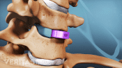 Medical illustration showing anterior cervical discectomy and fusion (ACDF) for cervical degenerative disc disease