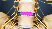 Bone graft healing over the implant and fusing L4 and L5 together