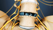 Anterior view of the lumbar store showing a cage between two vertebrae.