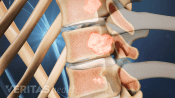 Profile view of spinal tumor in the vertebrae.