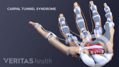 Palmar view of the pain in the tendons of the hand from carpal tunnel syndrome.