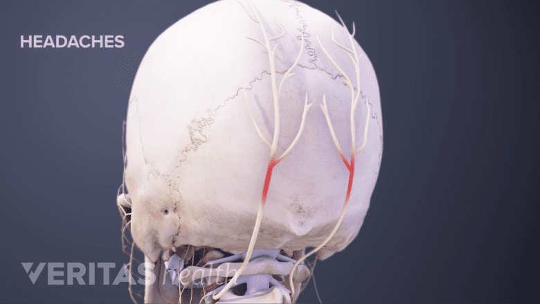 A Medical illustration showing headache.