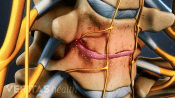 Inflammation from cervical degenerative disc disease in between two vertebrae.