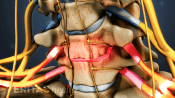Anterior view of nerve root compression from cervical degenerative disc disease