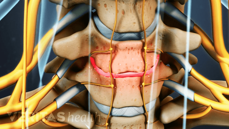 Illustration showing cervical disc degeneration.