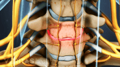 close up of cervical disc degeneration