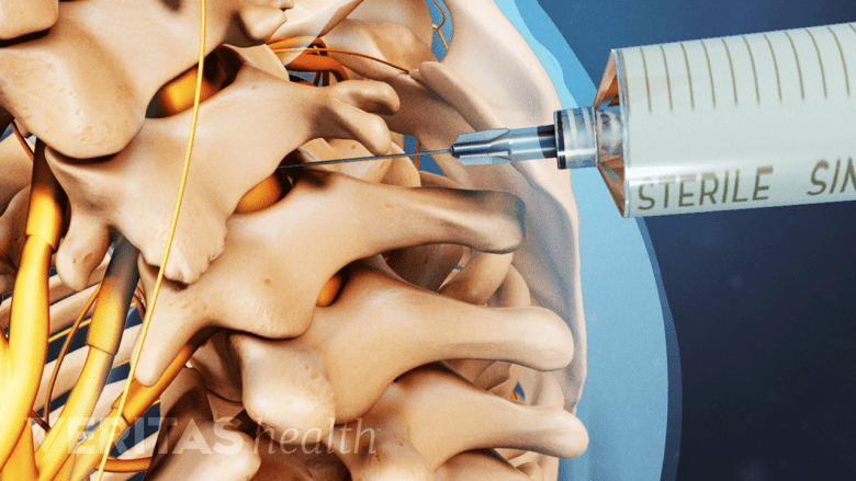 An illustration showing the spine with a needle inserted into the vertebra.