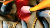Closeup of a cervical osteophyte on the facet joint