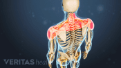 Posterior view highlighting pain in the upper back and shoulders.
