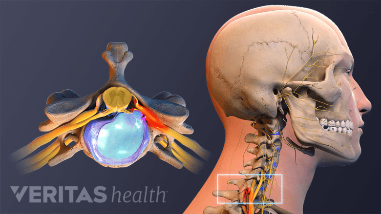 Illustration showing  side view of a skeleton and cervical herniated disc.