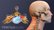 Profile and superior views of herniated discs in the cervical spine.