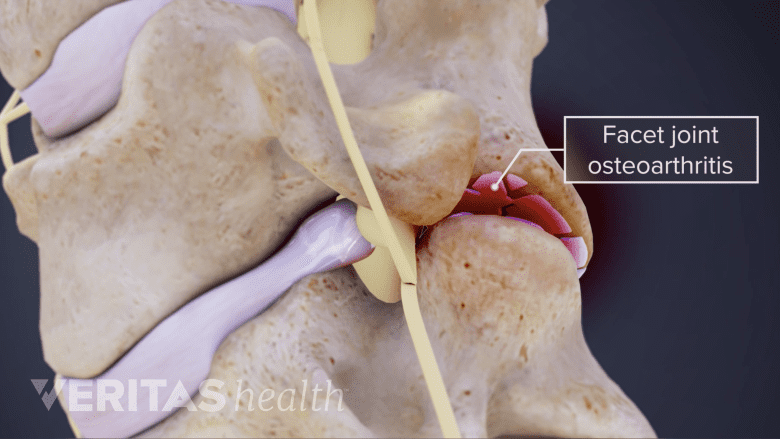 Illustration showing facet joint arthritis.