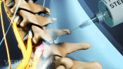 Selective nerve root block being injected into the cervical spine