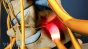 Profile view of bone spurs in the cervical spine.