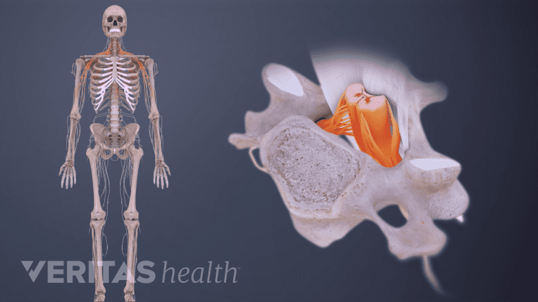 Illustration showing cervical spondylosis.