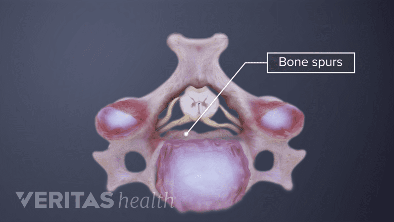Illustration showing cervical spine with bone spurs.