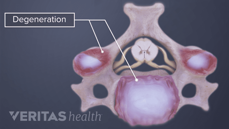 An illustration of Adult cervical spine with degenerated area in red.