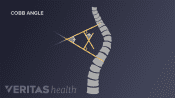 Spine showing the Cobb Angle of a thoracic scoliosis curve
