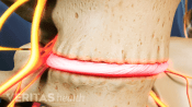 Close up of two vertebrae showing pain in the disc between.
