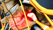 Profile view of compressed nerve root in the cervical spine.