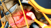 Profile view of compressed nerve root in the cervical spine.