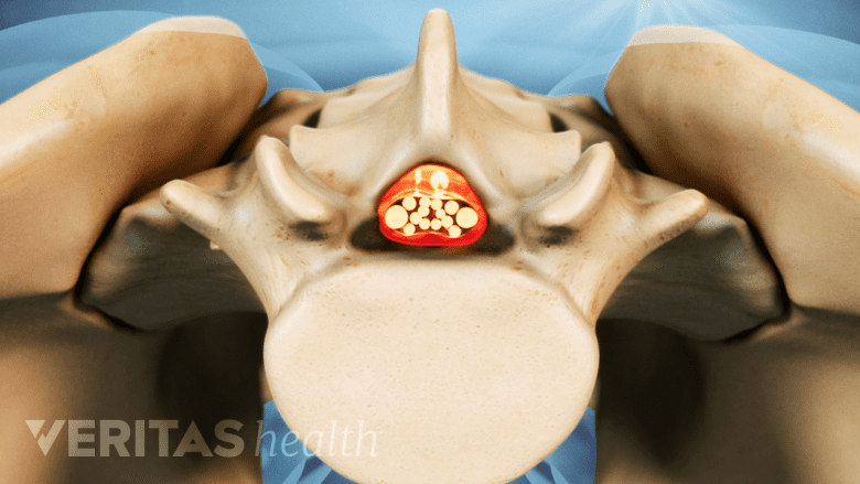 An illustration showing lumbar vertebra with the central canal highlighted in red.