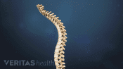 Curvature of the spine showing Scheuermann&#039;s Disease