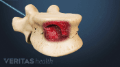 Profile view of vertebra showing compression fracture and the removal of the balloon tamp.