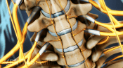 Anterior view to show a cervical degenerative disc.