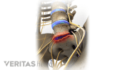 Anterior view of a degenerated disc in the lumbar spine.