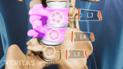 Lumbar degenerated disc in L3 and L4.