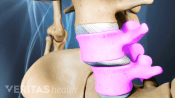 Anterior view of Spondylolisthesis in L4-L5.
