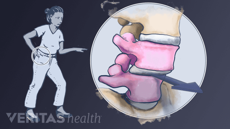 An illustration showing one vertebra slipping over the other.