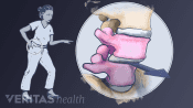 Woman in pain and a close up of the shift in vertebra causing degenerative spondylolisthesis.