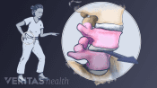 Woman in pain and a close up of the shift in vertebra causing degenerative spondylolisthesis.