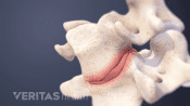 Showing a spinal disc in pain.