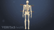 Posterior view of a spine with degenerative scoliosis curve